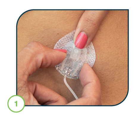 finger_on_front_of_cannula_housing_and_other_hand_squeezing_the_sides.png