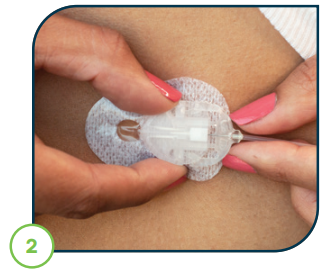 Image_of_removing_disconnect_cover_from_cannula_housing.PNG
